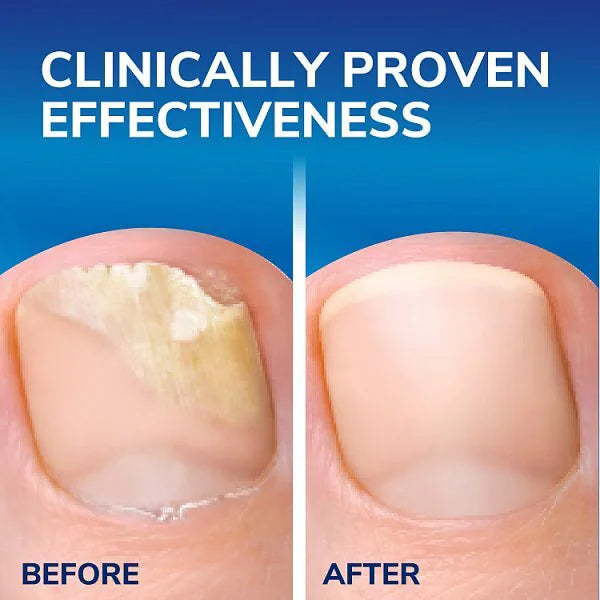 Dr. Scholl's Fungal Nail 2 in 1 Treat & Shield 3.8ml